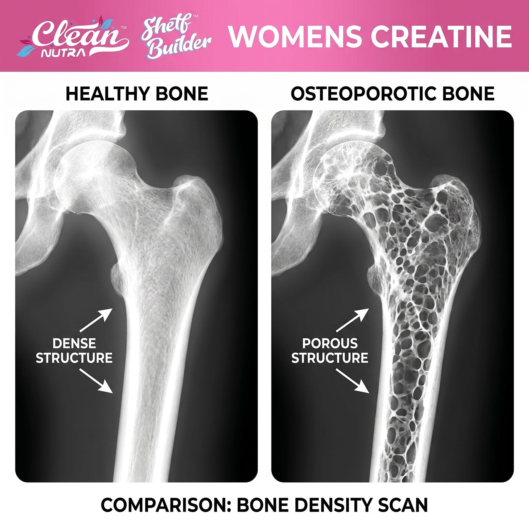 X-ray comparison healthy vs osteoporotic bone density